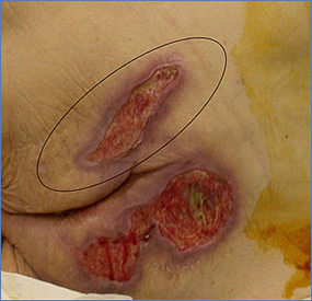 stage 4 pressure ulcer picture