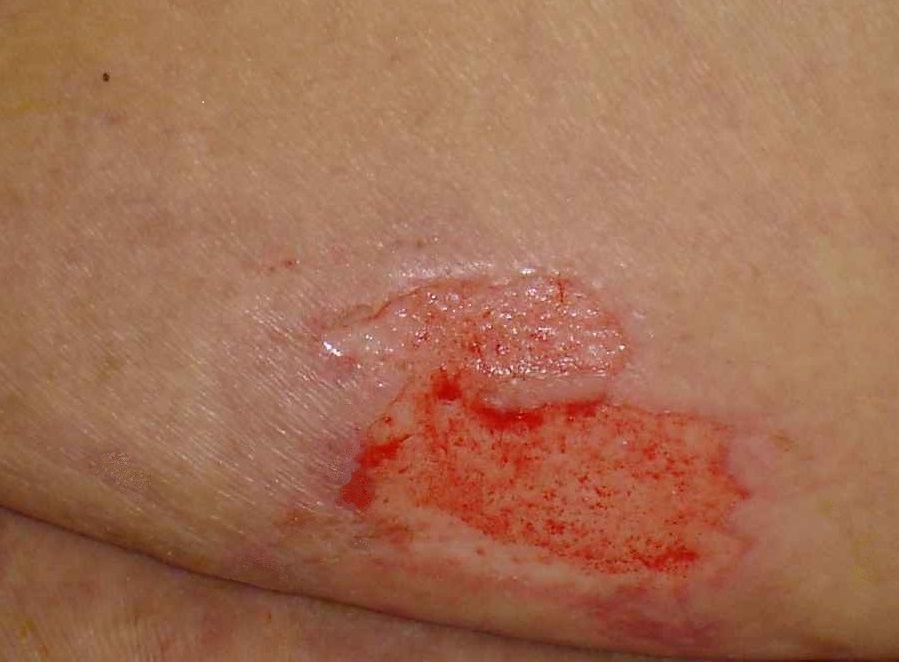 Stages of Pressure Sores - WebMD