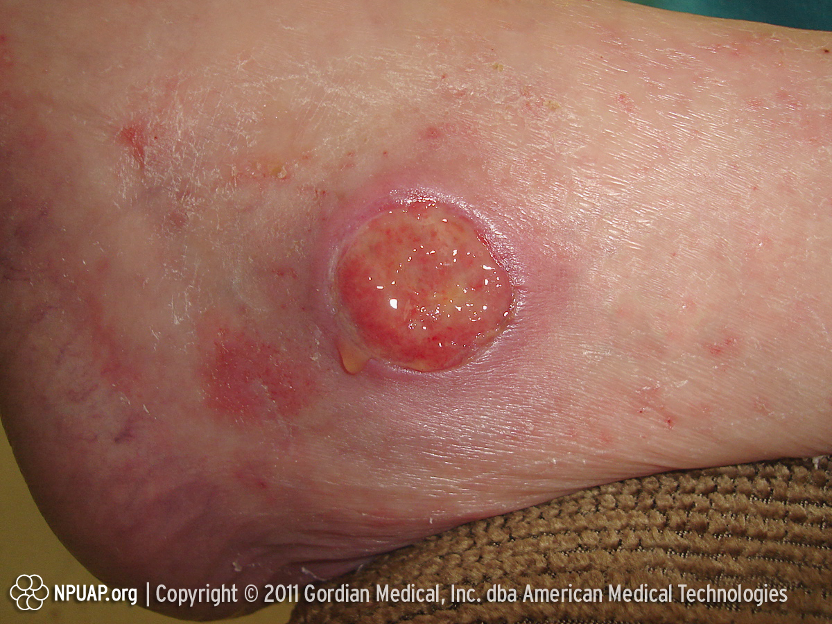 Pressure Ulcer Staging Pictures Pictures, Images & Photos ...