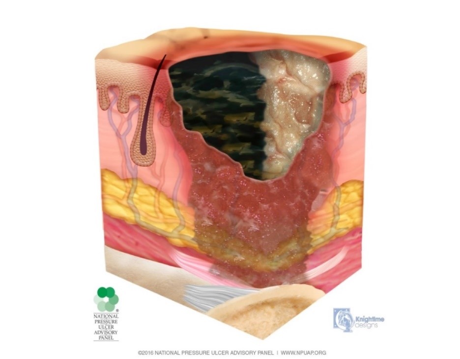 pressure-ulcer